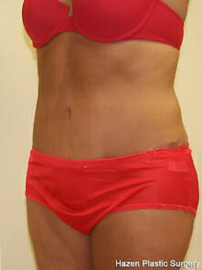 Tummy Tuck Before & After Gallery - Patient 9605612 - Image 4