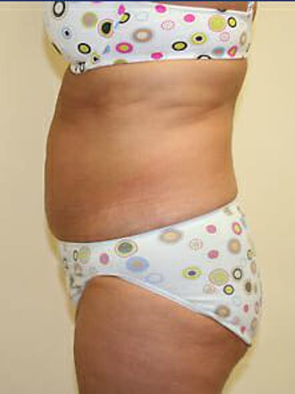 Tummy Tuck Before & After Gallery - Patient 9605612 - Image 5