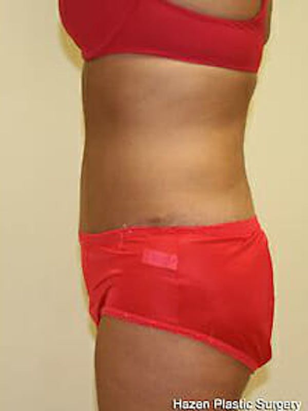 Tummy Tuck Before & After Gallery - Patient 9605612 - Image 6