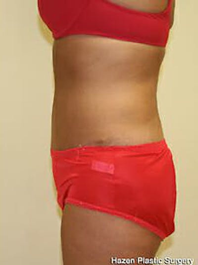 Tummy Tuck Gallery - Patient 9605612 - Image 6