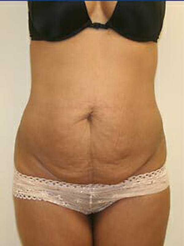 Tummy Tuck Gallery - Patient 9605614 - Image 1
