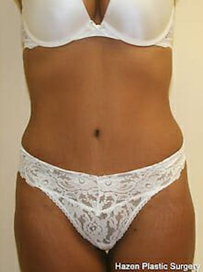 Tummy Tuck Before & After Gallery - Patient 9605614 - Image 2