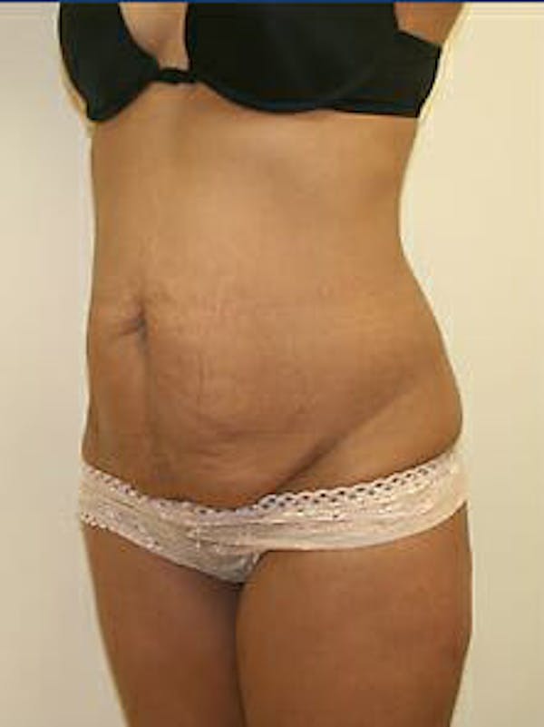 Tummy Tuck Before & After Gallery - Patient 9605614 - Image 3