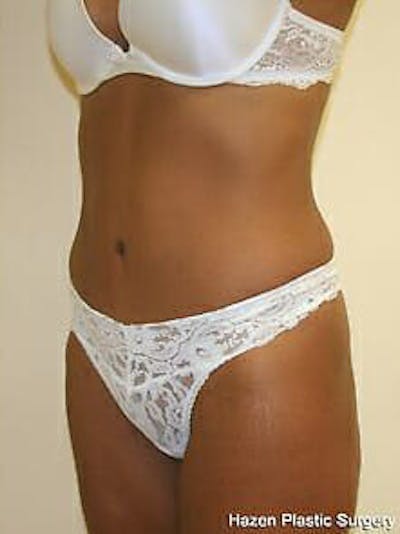 Tummy Tuck Before & After Gallery - Patient 9605614 - Image 4