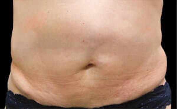 CoolSculpting® Elite Before & After Gallery - Patient 9605619 - Image 1