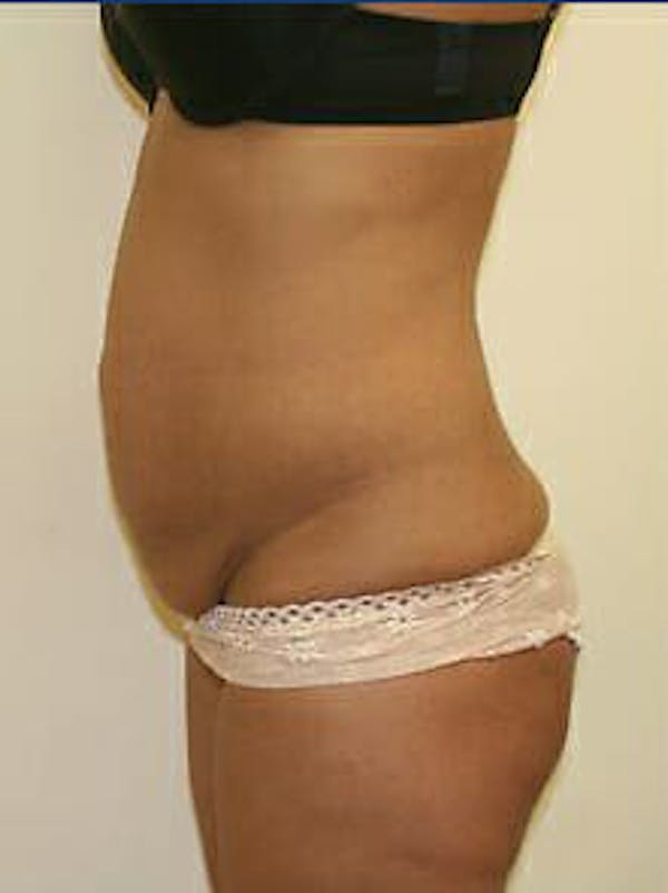 Tummy Tuck Before & After Gallery - Patient 9605614 - Image 5