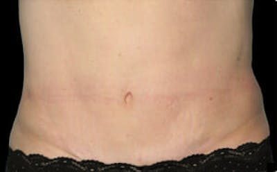 CoolSculpting® Elite Before & After Gallery - Patient 9605619 - Image 2