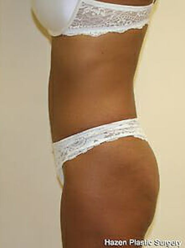Tummy Tuck Before & After Gallery - Patient 9605614 - Image 6