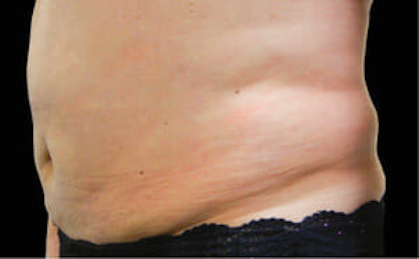 CoolSculpting® Elite Before & After Gallery - Patient 9605619 - Image 3