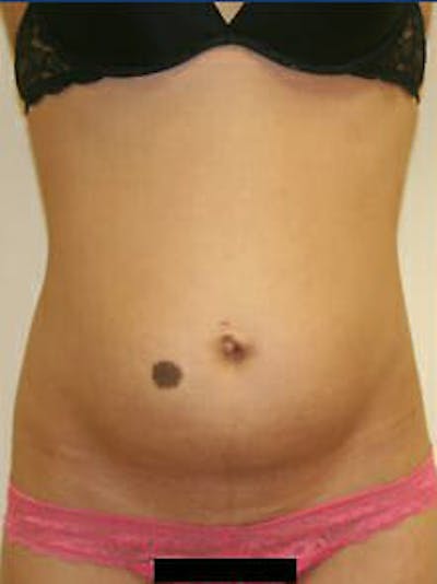 Tummy Tuck Before & After Gallery - Patient 9605621 - Image 1