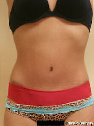 Tummy Tuck Before & After Gallery - Patient 9605621 - Image 2