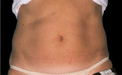 CoolSculpting® Before & After Gallery - Patient 9605620 - Image 1