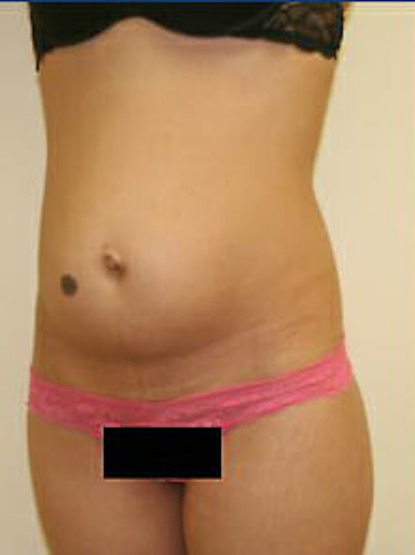 Tummy Tuck Before & After Gallery - Patient 9605621 - Image 3