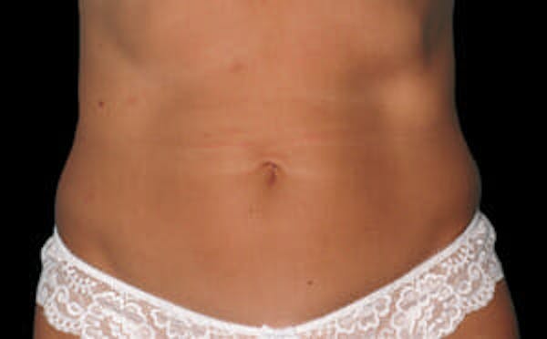 CoolSculpting® Elite Before & After Gallery - Patient 9605620 - Image 2