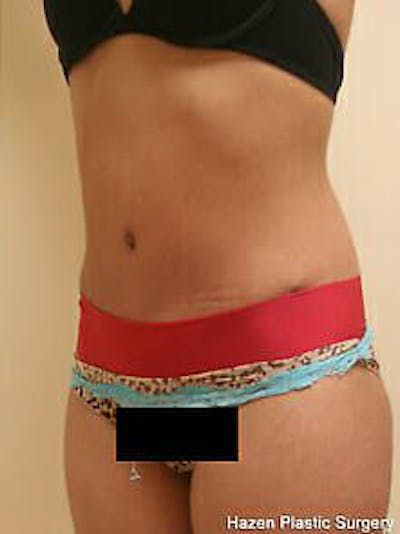 Tummy Tuck Before & After Gallery - Patient 9605621 - Image 4