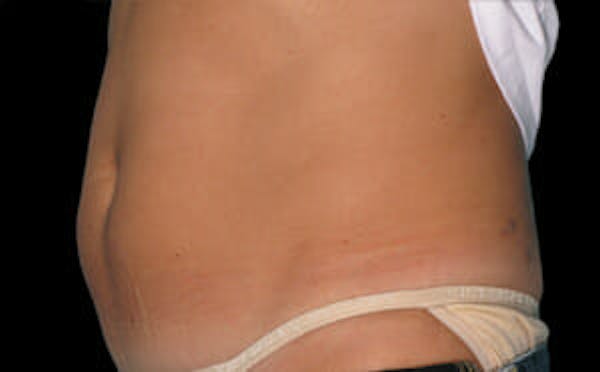 CoolSculpting® Elite Before & After Gallery - Patient 9605620 - Image 3