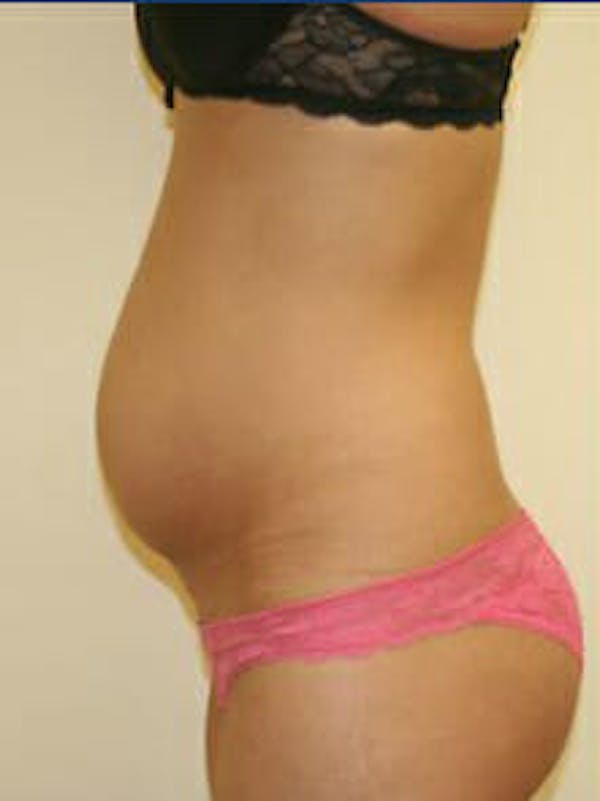 Tummy Tuck Before & After Gallery - Patient 9605621 - Image 5