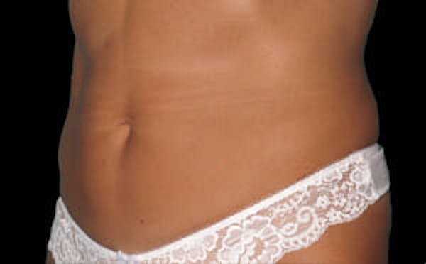 CoolSculpting® Gallery - Patient 9605620 - Image 4