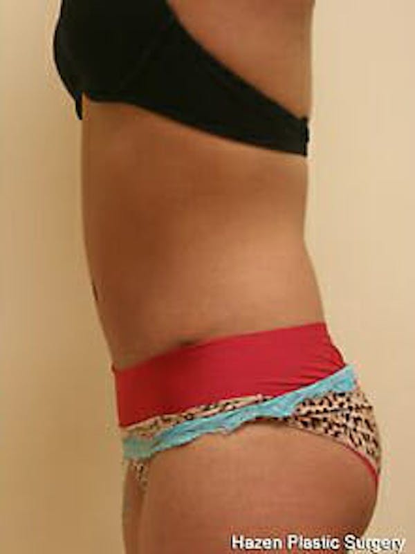Tummy Tuck Before & After Gallery - Patient 9605621 - Image 6
