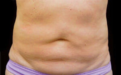 CoolSculpting® Before & After Gallery - Patient 9605622 - Image 1
