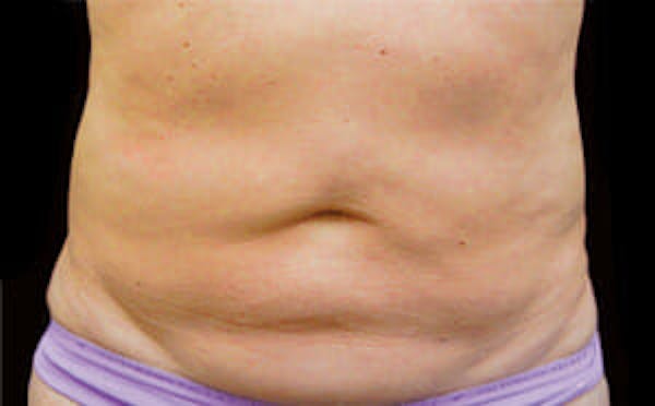 CoolSculpting® Elite Before & After Gallery - Patient 9605622 - Image 1