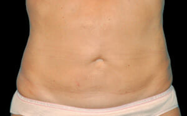 CoolSculpting® Elite Before & After Gallery - Patient 9605622 - Image 2