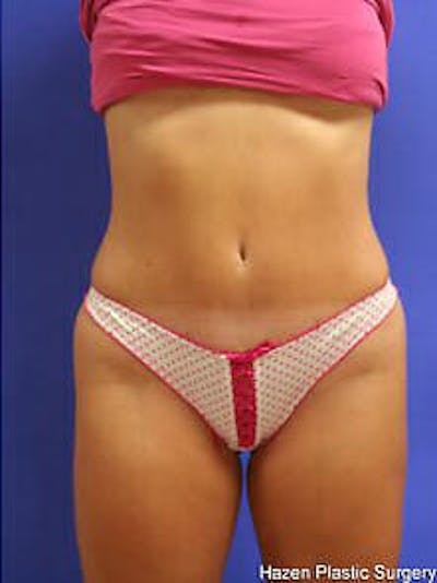 Tummy Tuck Before & After Gallery - Patient 9605625 - Image 2