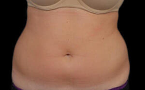 CoolSculpting® Elite Before & After Gallery - Patient 9605624 - Image 1