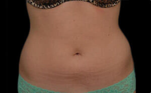 CoolSculpting® Elite Before & After Gallery - Patient 9605624 - Image 2