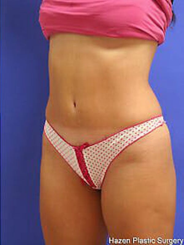 Tummy Tuck Before & After Gallery - Patient 9605625 - Image 4