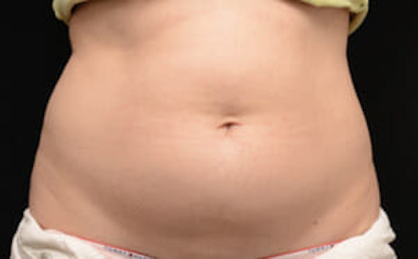 CoolSculpting® Elite Before & After Gallery - Patient 9605626 - Image 1