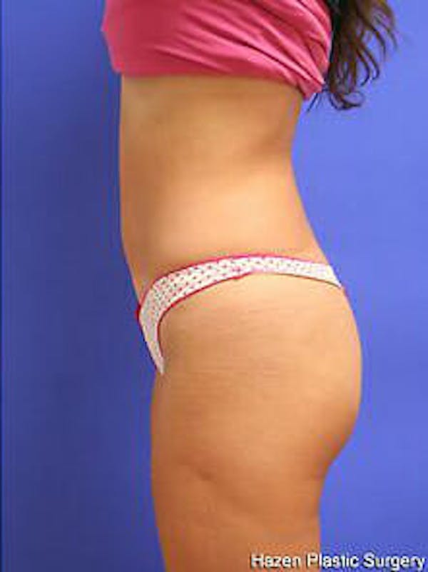 Tummy Tuck Before & After Gallery - Patient 9605625 - Image 6