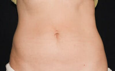 CoolSculpting® Before & After Gallery - Patient 9605626 - Image 2