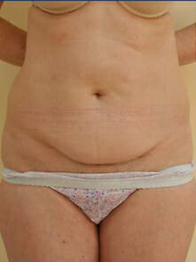 Tummy Tuck Before & After Gallery - Patient 9605630 - Image 1