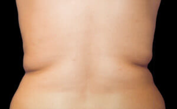 CoolSculpting® Elite Before & After Gallery - Patient 9605627 - Image 1