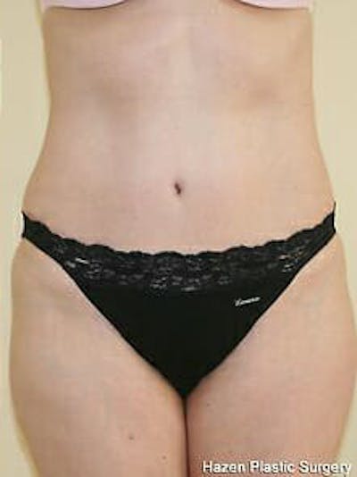 Tummy Tuck Before & After Gallery - Patient 9605630 - Image 2