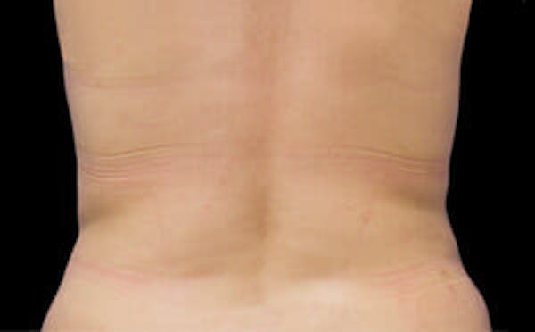 CoolSculpting® Elite Before & After Gallery - Patient 9605627 - Image 2