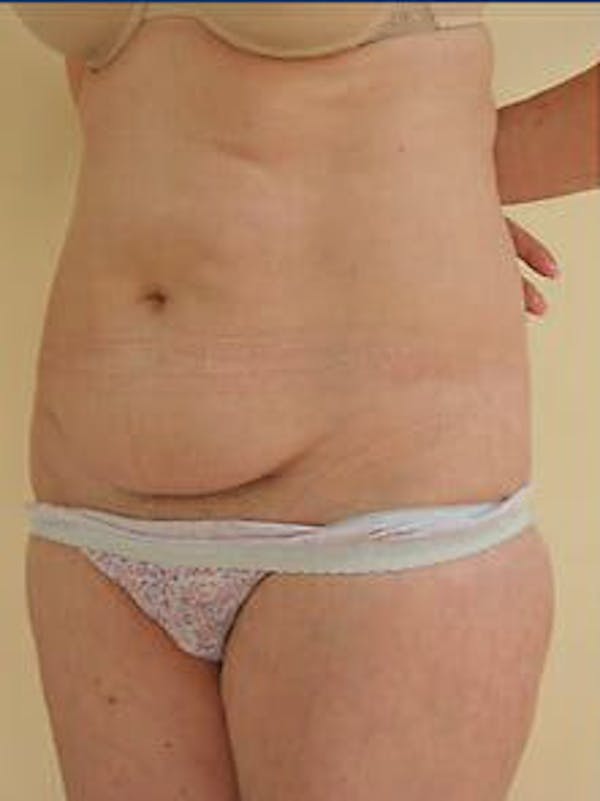 Tummy Tuck Before & After Gallery - Patient 9605630 - Image 3