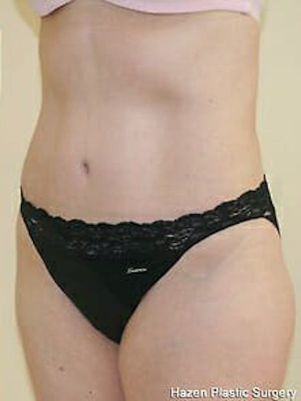Tummy Tuck Before & After Gallery - Patient 9605630 - Image 4