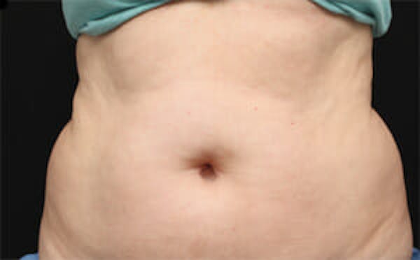 CoolSculpting® Elite Before & After Gallery - Patient 9605629 - Image 1