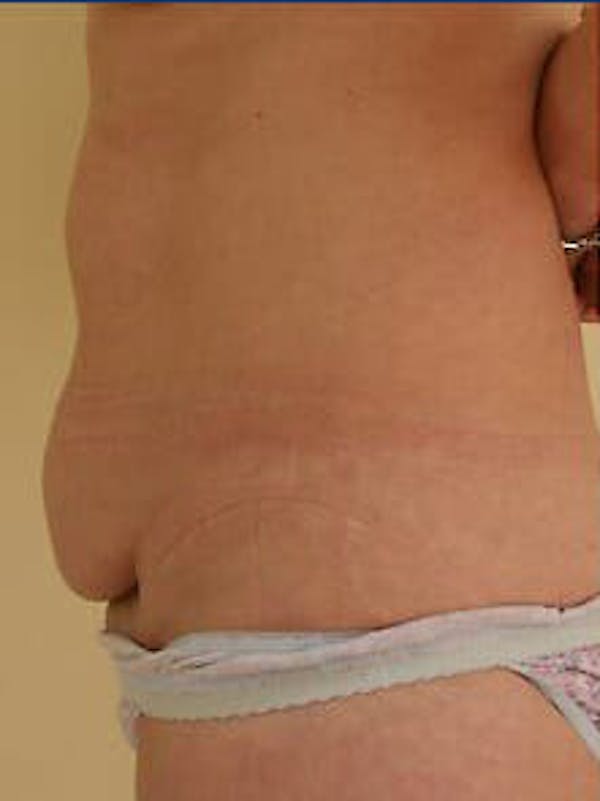 Tummy Tuck Before & After Gallery - Patient 9605630 - Image 5
