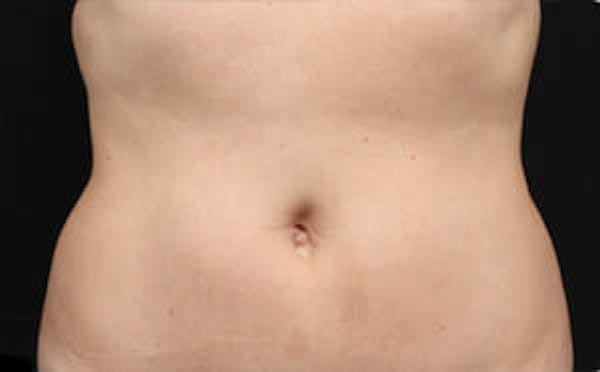 CoolSculpting® Elite Before & After Gallery - Patient 9605629 - Image 2