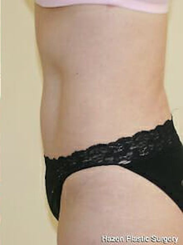 Tummy Tuck Before & After Gallery - Patient 9605630 - Image 6