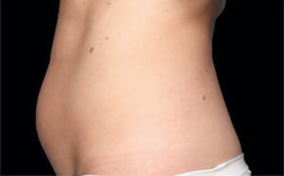 CoolSculpting® Gallery - Patient 9605631 - Image 1