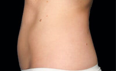 CoolSculpting® Gallery - Patient 9605631 - Image 2