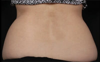 CoolSculpting® Before & After Gallery - Patient 9605633 - Image 1