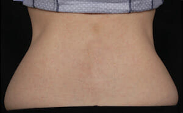 CoolSculpting® Elite Before & After Gallery - Patient 9605633 - Image 2