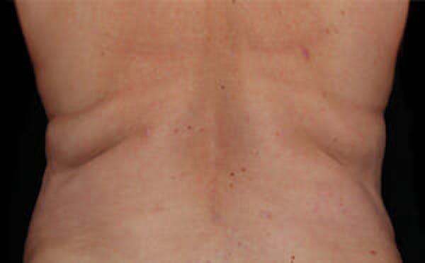 CoolSculpting® Gallery - Patient 9605634 - Image 1