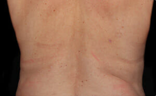 CoolSculpting® Elite Before & After Gallery - Patient 9605634 - Image 2