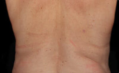 CoolSculpting® Before & After Gallery - Patient 9605634 - Image 2